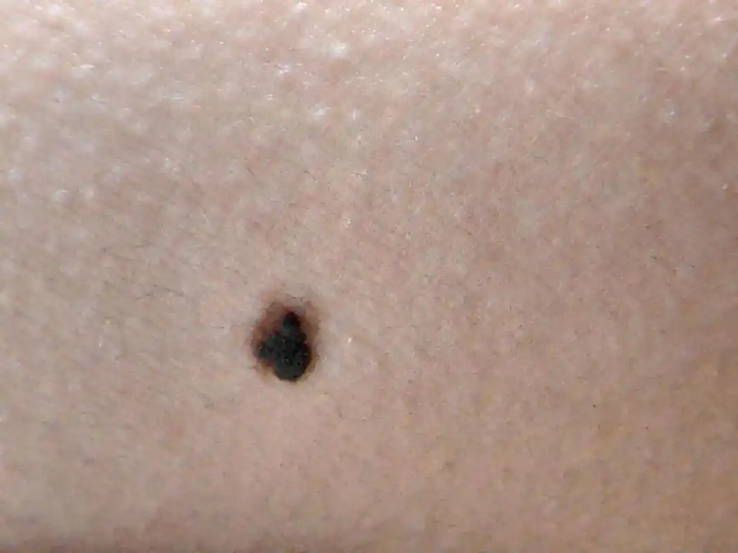 在抖音上刷到黑色素瘤痣的后怕,吓的我赶紧去医院看看身上的两颗痣