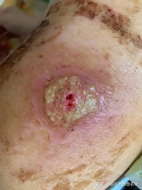 自己处理两次不同的火疖子