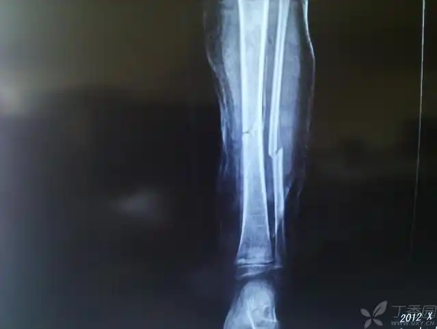 小儿胫腓骨骨折的保守治疗