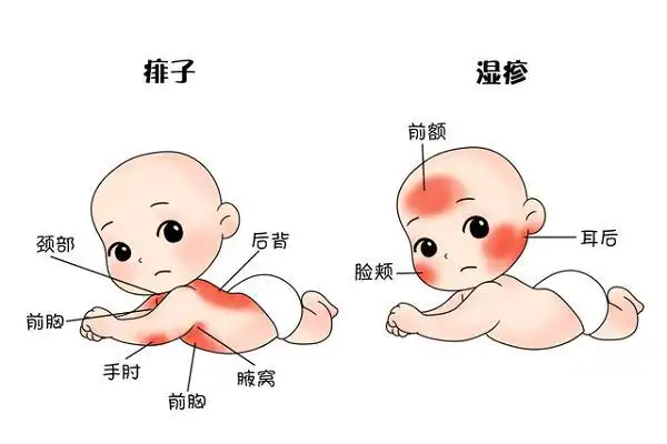 痱子和湿疹护理有别