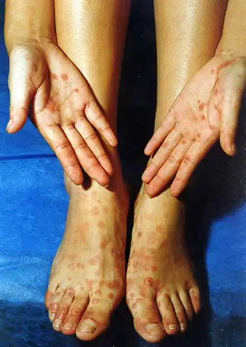 一期梅毒图片——肛门部硬下疳图片_有来医生