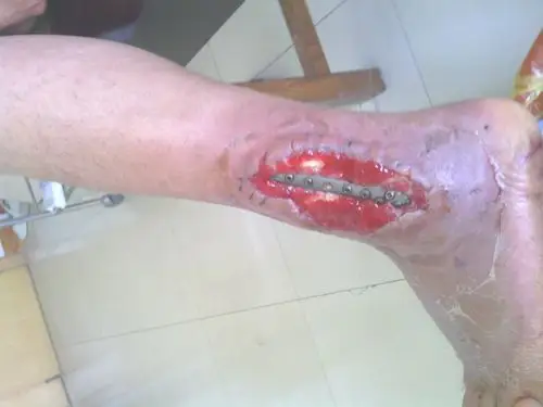 外踝骨折术后切口感染并钢板外漏,怎么办?