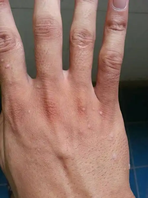 1 分钟前严大伟 实习医师来自山东济宁医学院 答: 这个有点像是寻常疣