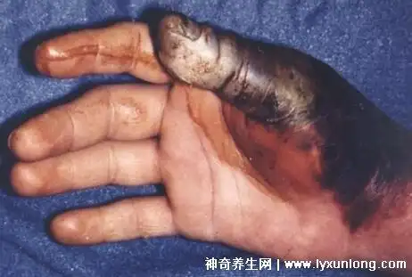 感染黑死病的样子图片浑身长黑斑淋巴结肿成鸡蛋大小