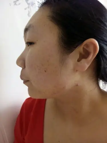 脸上有很多痘疤.谁有什么妙方.最好是自己用过且效果不错的.在线等