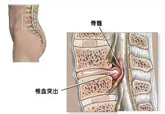 腰椎间盘突出症图片