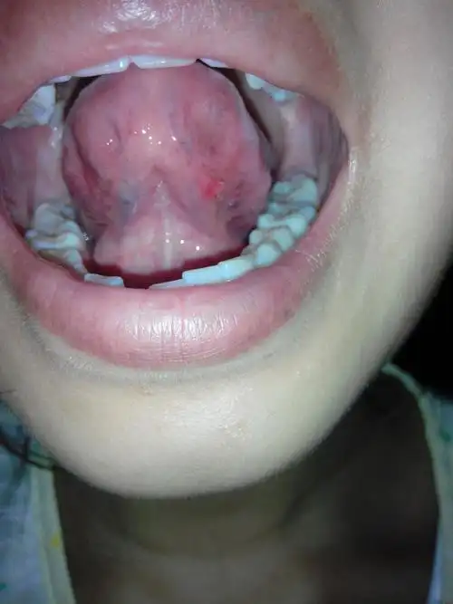 舌头下面长了个这个 怎么了