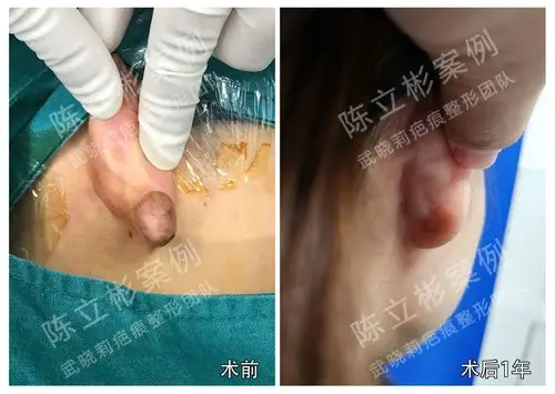 耳部疤痕疙瘩术后1年复诊记录原创