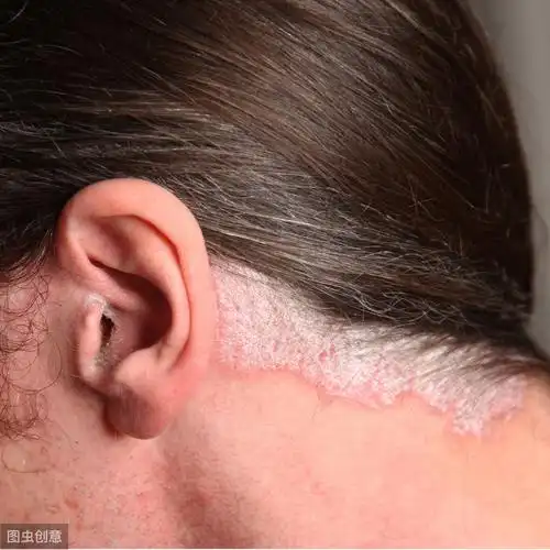 世界银屑病日,全面认识头皮银屑病,科学诊治,用药,护理