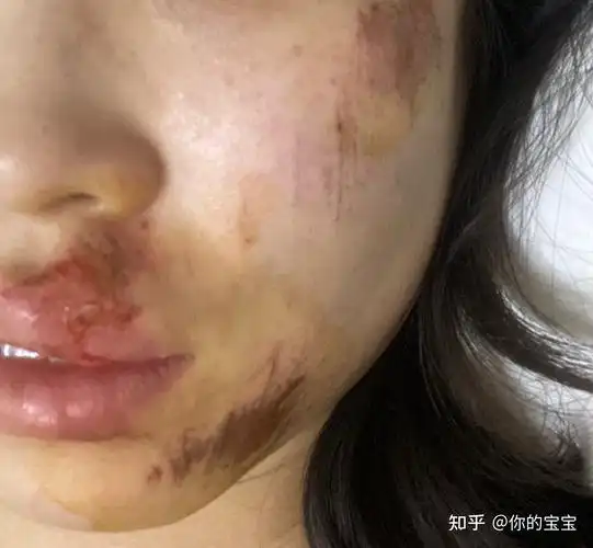 脸部擦伤如图请问如何恢复