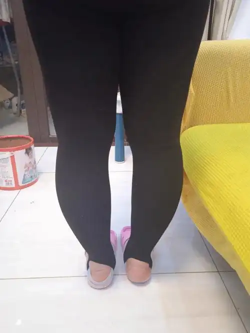 见过这种腿吗膝外翻手术
