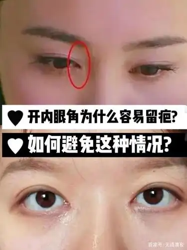 开内眼角为什么容易留疤?如何避免这种情况
