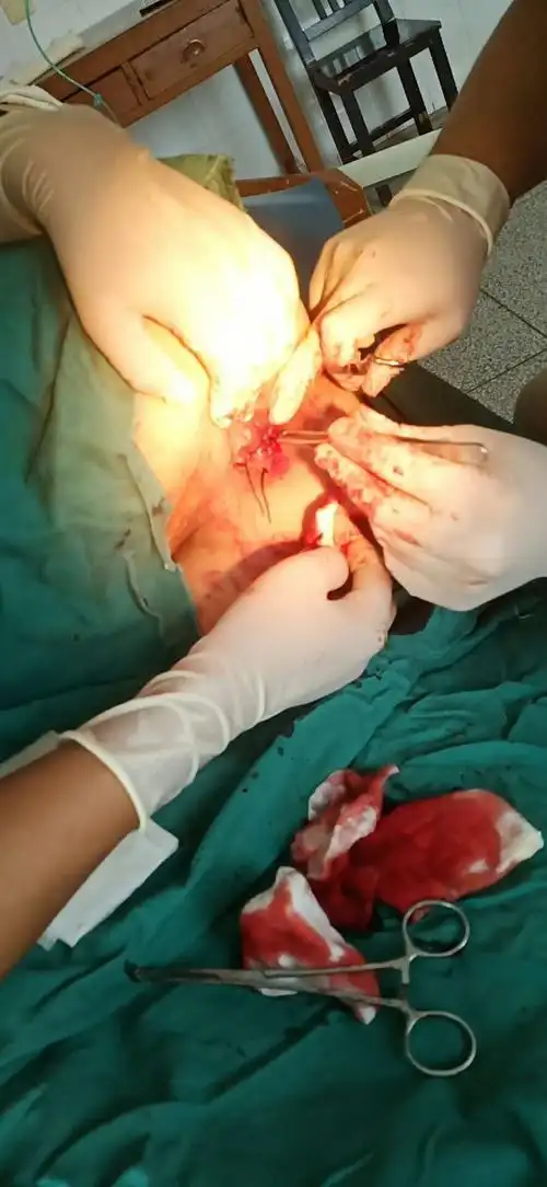 9点到6点齿线下切除外痔,清除血栓,间断缝合.