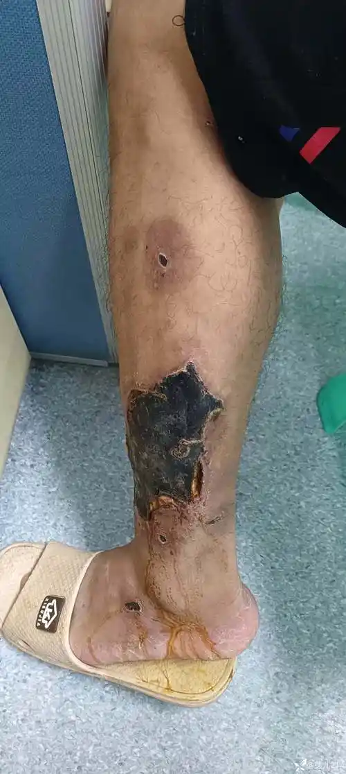 31岁男性患者出现皮肤溃疡有什么原因导致的