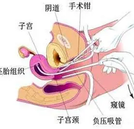 人流手术的优势与步骤介绍