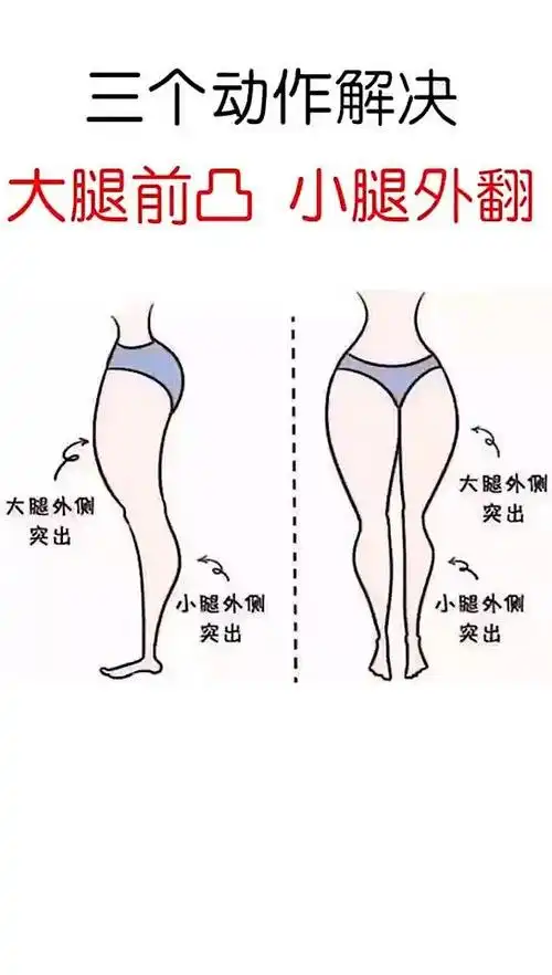 三个动作解决大腿前凸小腿外翻