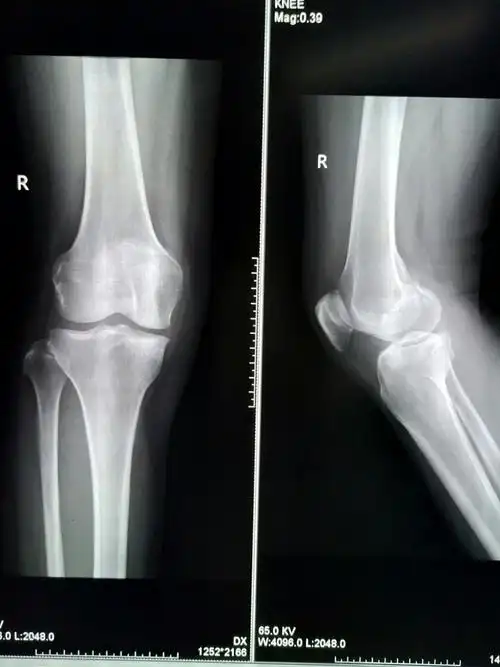 正常的膝关节,偶尔也会痛.