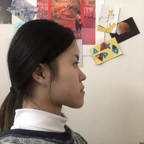 【骨性地包天 左右脸不对称】虽然觉得没什么机会被选_圈子-新氧美容