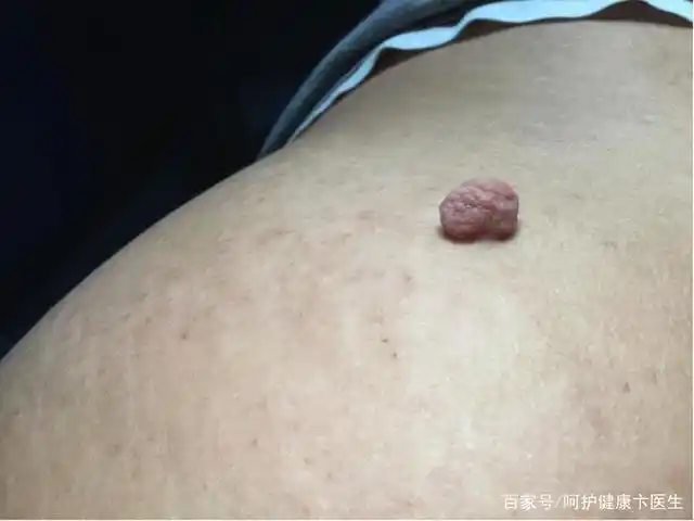 但是当该纤维瘤不断长大时,需要介入治疗.