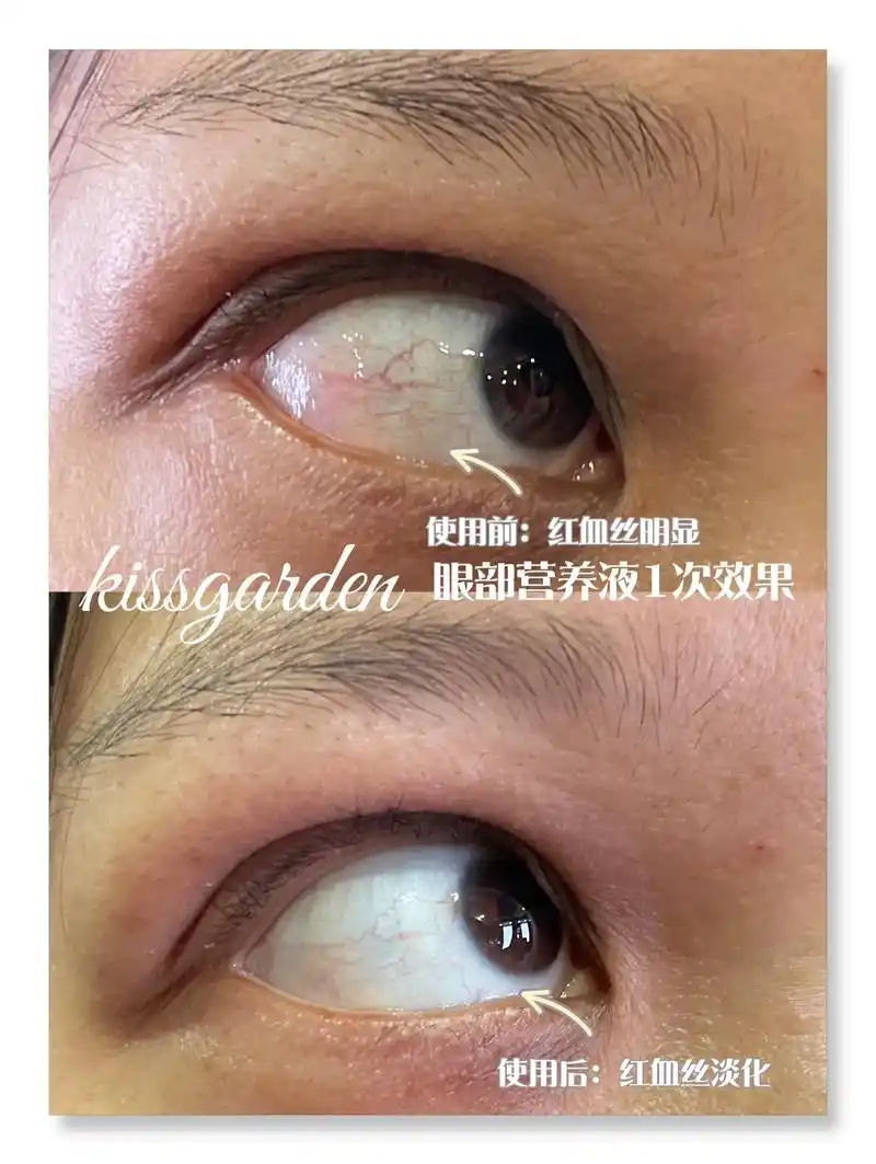 眼睛黄斑7575浑浊变清澈明亮.