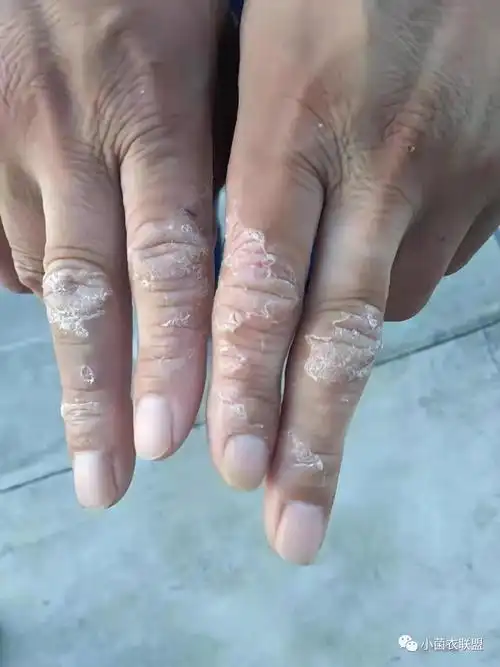 手足皲裂_发病原因_症状表现_治疗方式_日常注意事项 - 好大夫在线