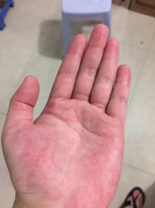 手掌一直这样红白相间,是怎么回事.