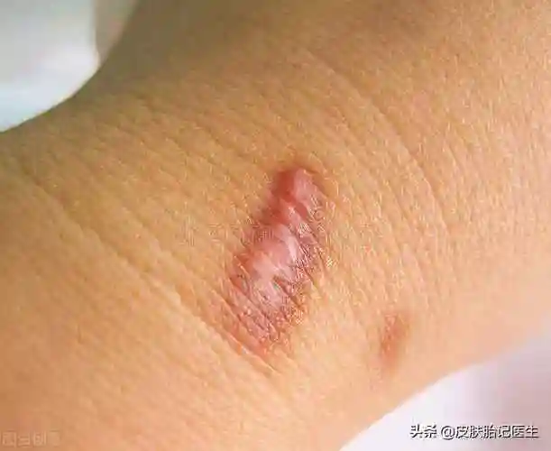 1,感染发炎创伤口在闭合过程中感染炎症,炎症因子刺激成纤维细胞增生