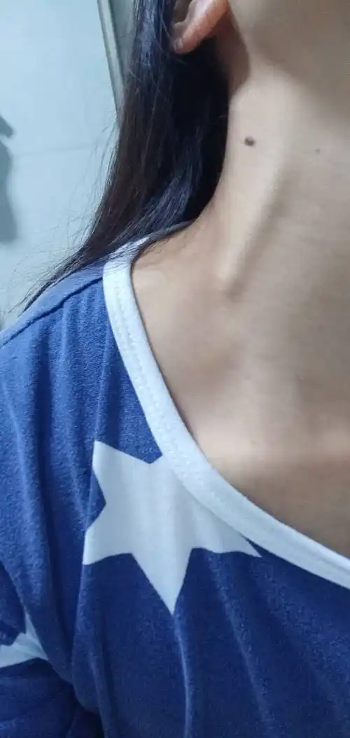 如图下 脖子上动脉突然变粗了 但没什么异常不舒服 有人知道这是怎么