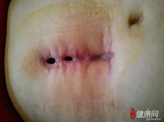 胃穿孔是怎么回事呢