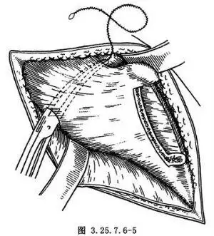 【髂骨延长术】髂骨延长术手术详细步骤,髂骨延长术手术过程_百姓健康