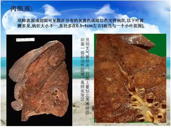 小叶性肺炎ppt课件ppt