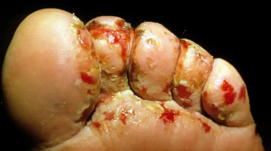 一般无瘙痒,但是可伴疼痛 好发于指(趾)缝 足癣尤其多见于3-4和4-5趾