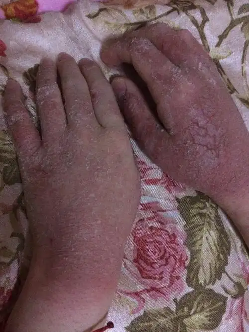 本人慢性钱币性湿疹