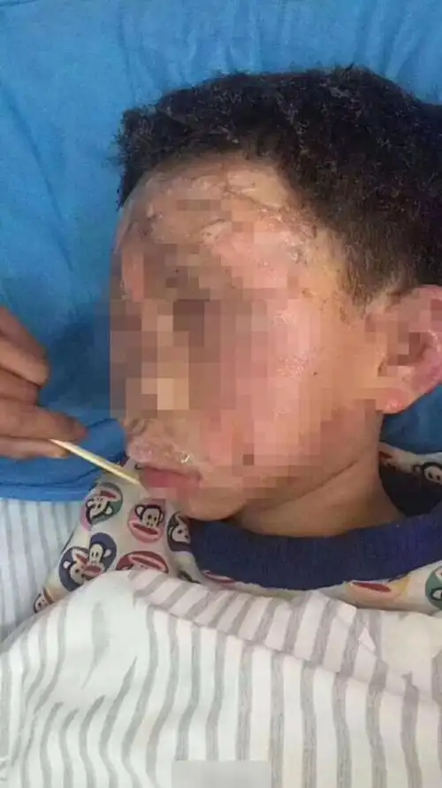重庆男童玩火烧伤脸,怕被父母责骂,讹称揭发偷车遭泼汽油烧伤