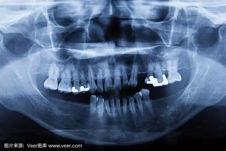 牙科用全景x光片