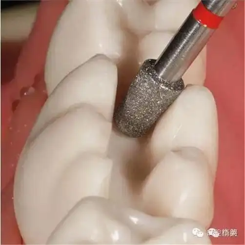 嵌体--修复体的制备和粘接要点