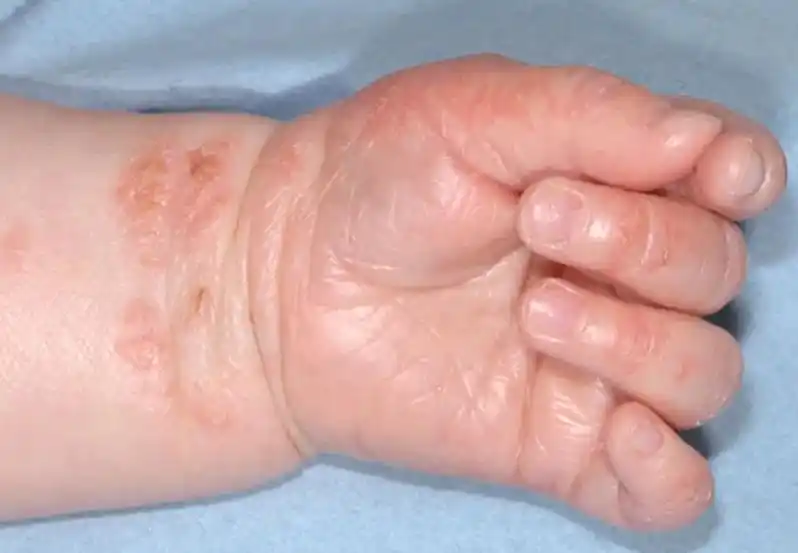 皮炎湿疹是一种皮肤病 - 抖音