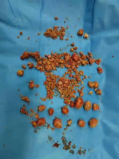 新版石头记延安市人民医院泌尿外科成功取出百余枚结石还患者一个干净