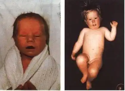 prader-willi综合征不同年龄段的临床表现(点击查看大图)并发症与病死