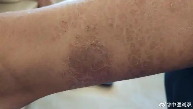 中医##湿疹#男,14岁,下肢皮肤干燥瘙痒,伴皮损1周,大的如铜钱,破舜Ζ