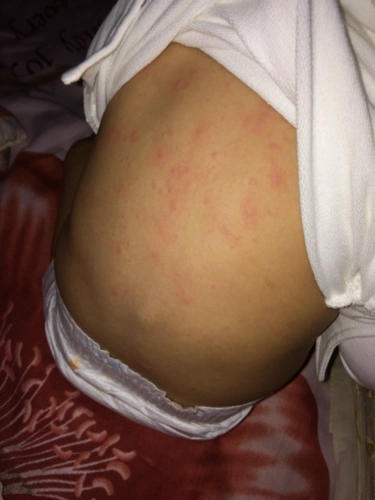 七个多月的宝宝荨麻疹该怎么治才能去根?