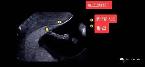 精细图解帆状胎盘等