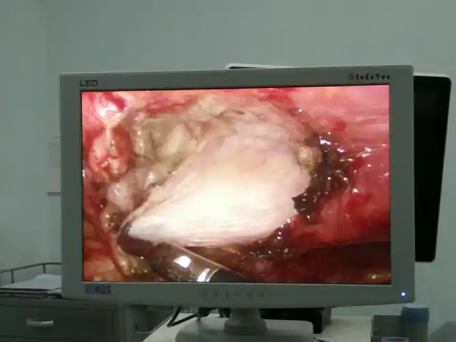 乳腺囊肿的腔镜微创手术 - 好大夫在线