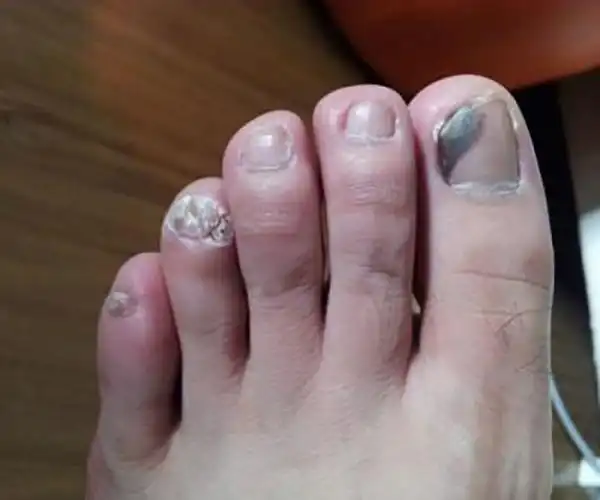 甲癣灰指甲图片