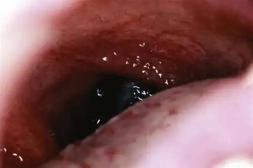 扁桃体恶性肿瘤