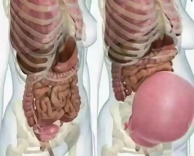 92生个孩子～ 变形的何止是身材 子宫变大2