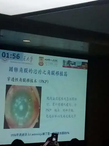 【柯碧莲】圆锥角膜早期诊断与治疗