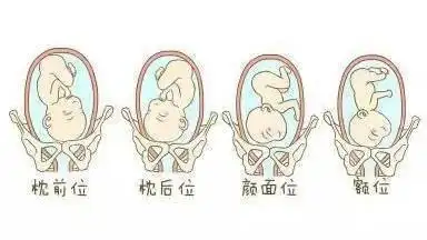 胎儿枕后位是什么?还能顺产吗?