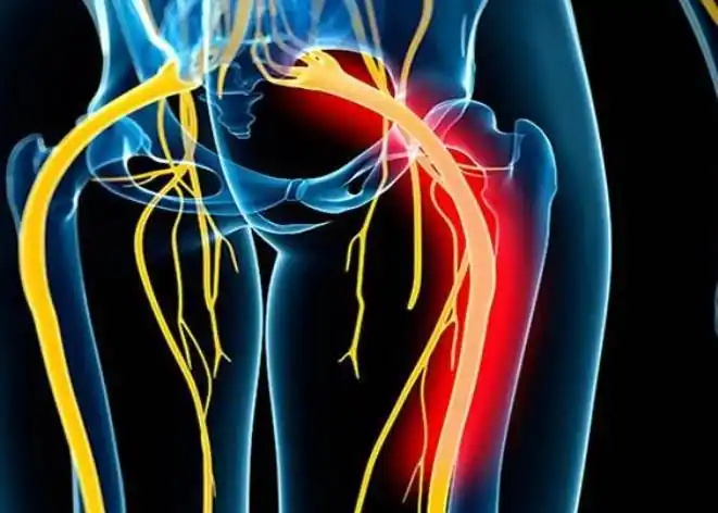 坐骨神经痛手术