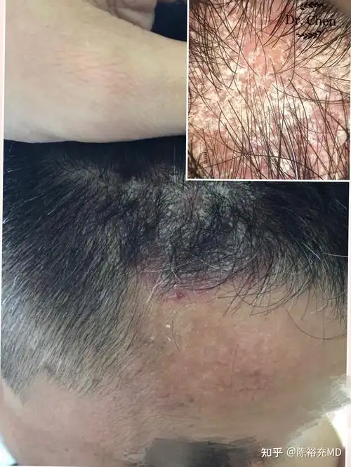 头皮屑多会有什么病吗